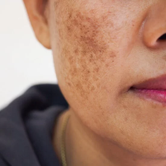 Marks, Pigmentation, Blemishes