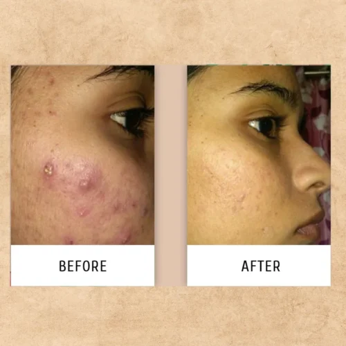 avarampoo soap clears acne marks