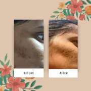 pimple soap moringa gel