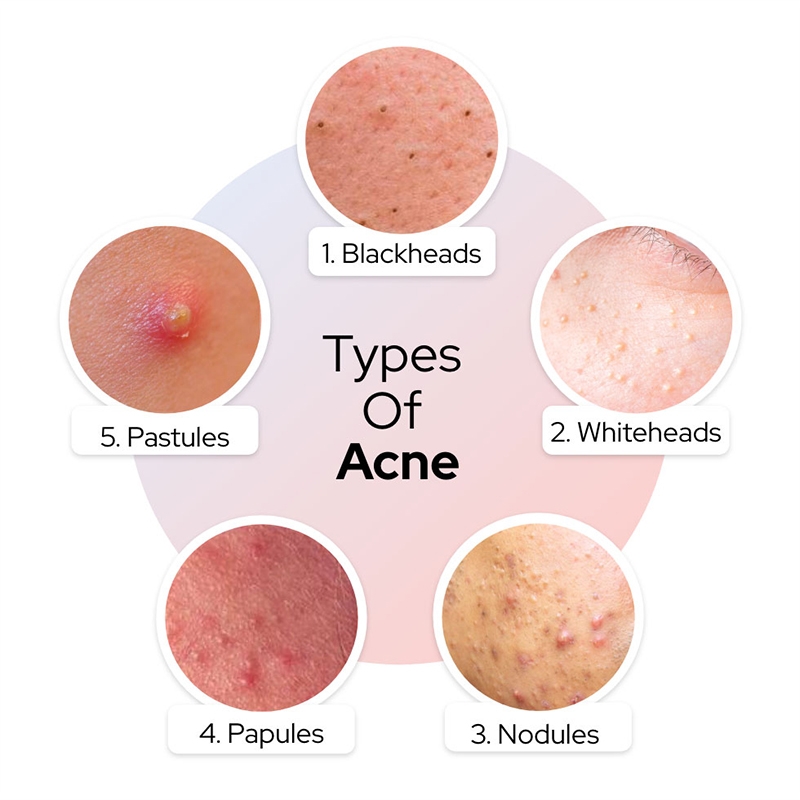 How to get rid of pimple and acne? - Araah Skin Miracle