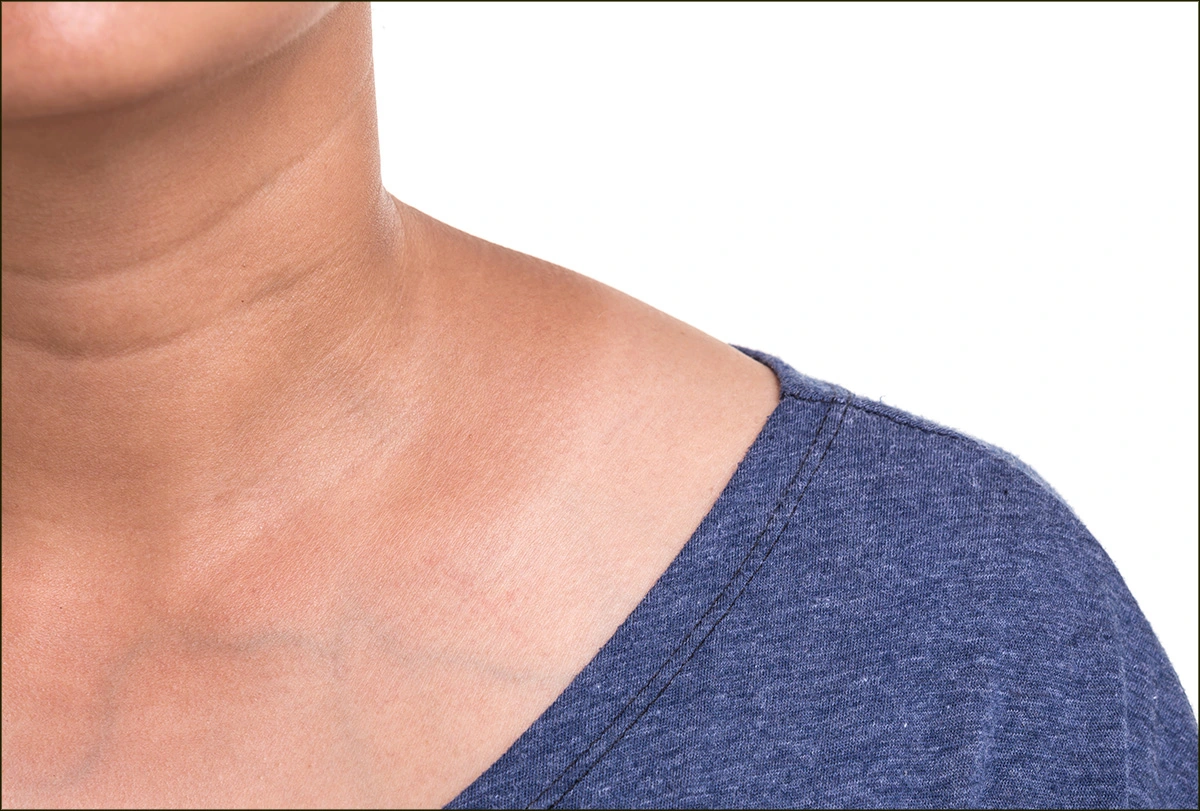 Triangles of the Neck: Anatomy | Concise Medical Knowledge